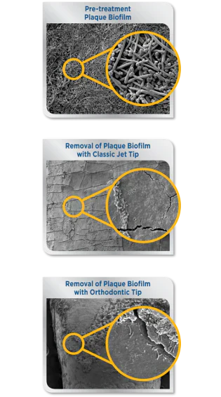 Waterpik™ Water Flosser Removes 99.9% of Plaque Biofilm After 3-Second Treatment