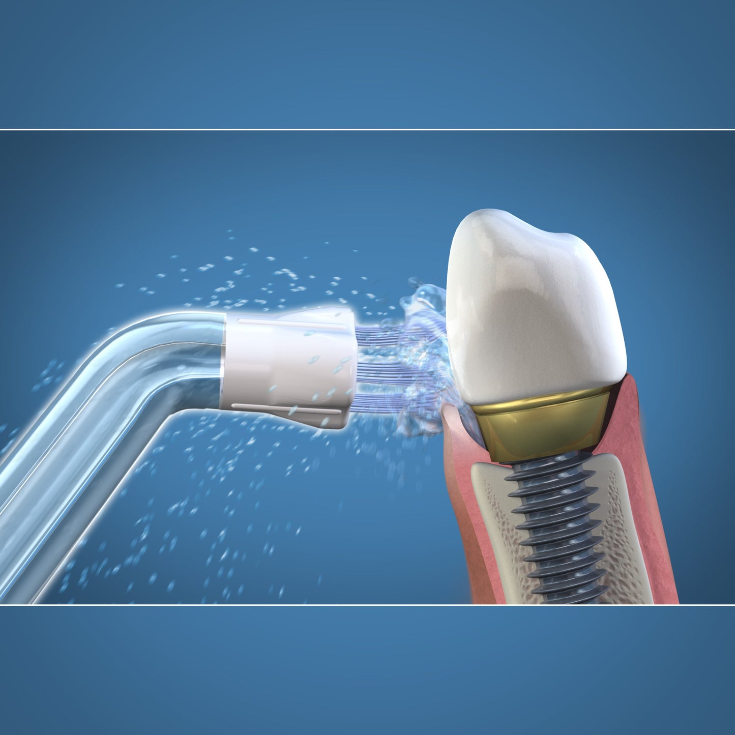 Using WPS-2E Whitening Plaque Seeker™ Tips
