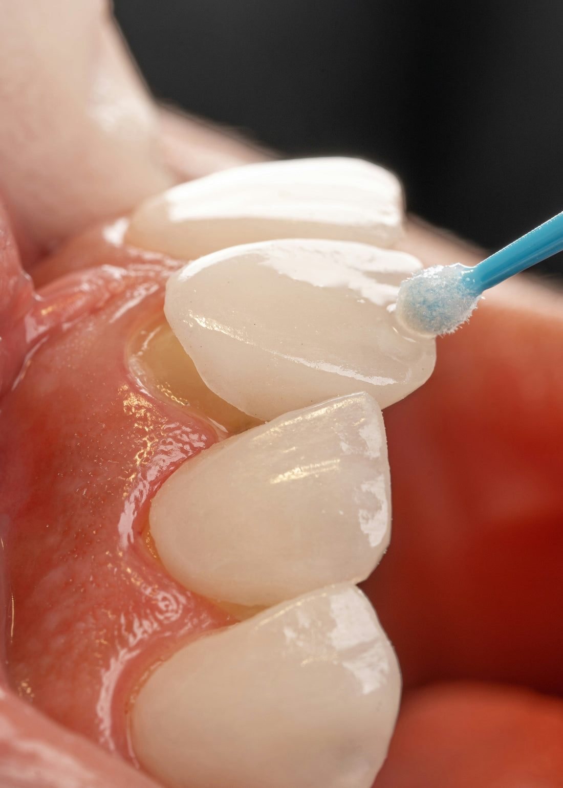 Crowns, Bridges & Veneers
