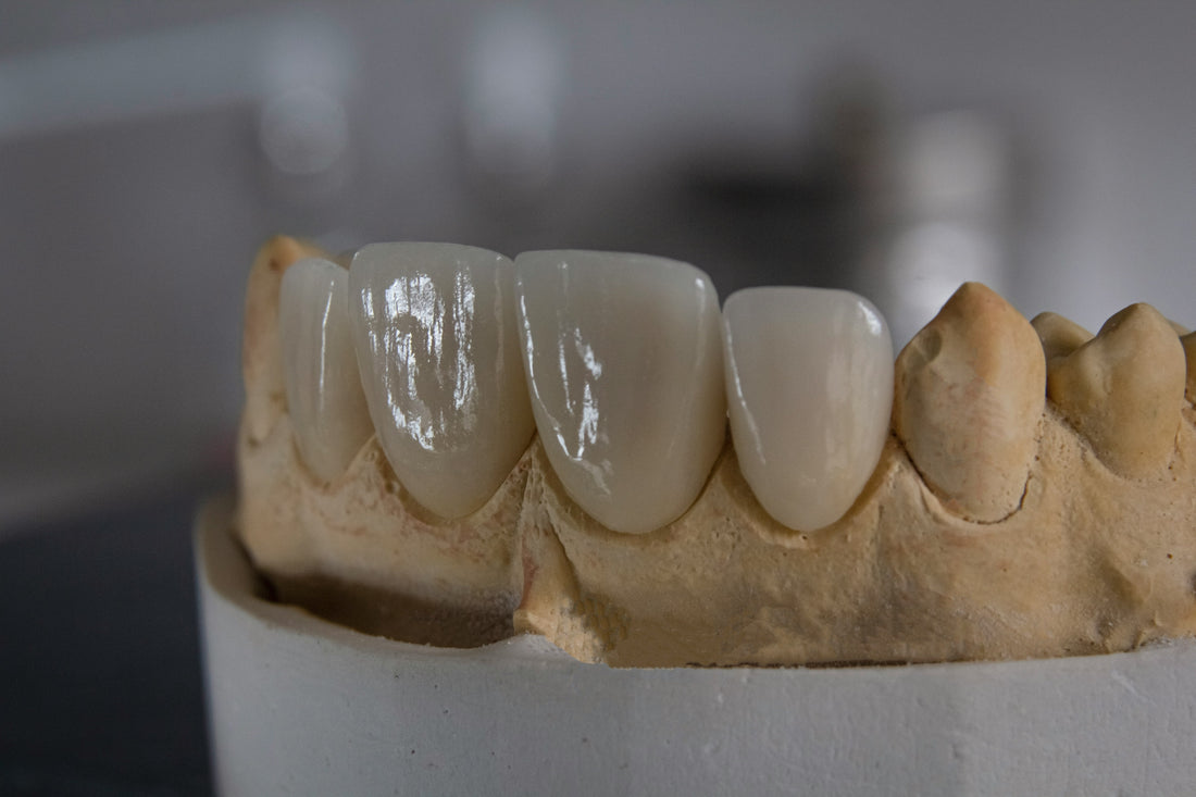 Crowns, Bridges & Veneers