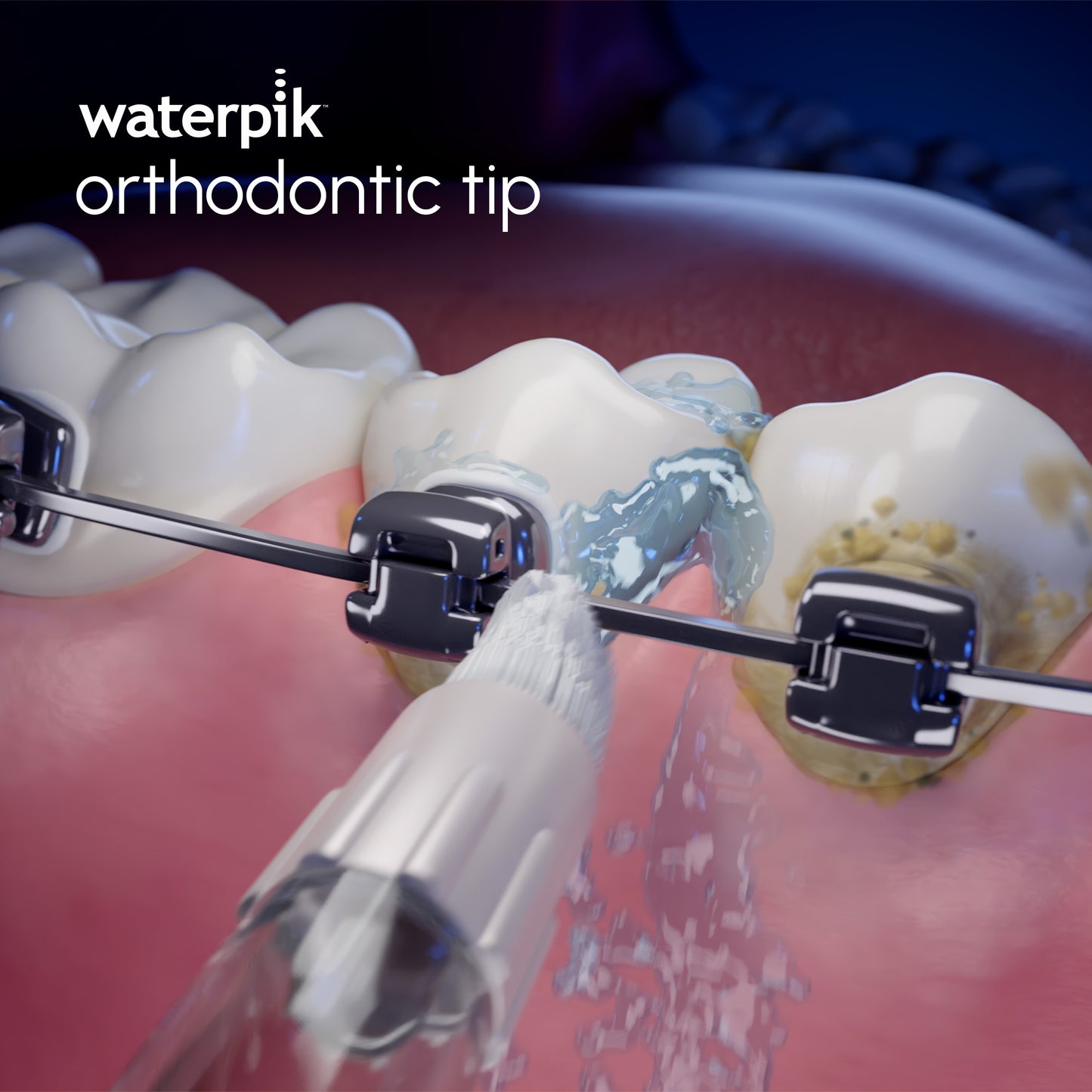 Orthodontic tip