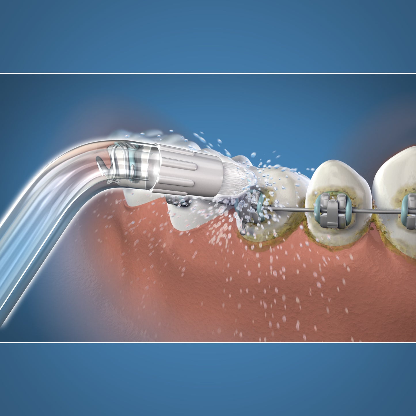 Using OD-100E Orthodontic Tips