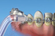 Water flosser cleaning teeth with braces