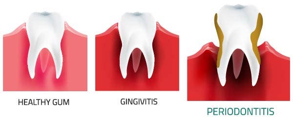 Healthy gum and gingivitis gum and periodontitis gum